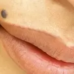Que disent vos grains de beauté de votre personnalité